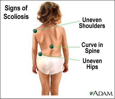 Identify Scoliosis