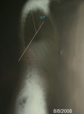 kyphosis after treatment