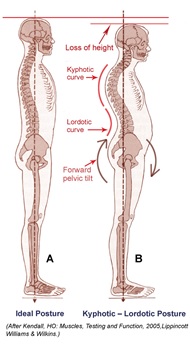 Kyphotic and Lordotic